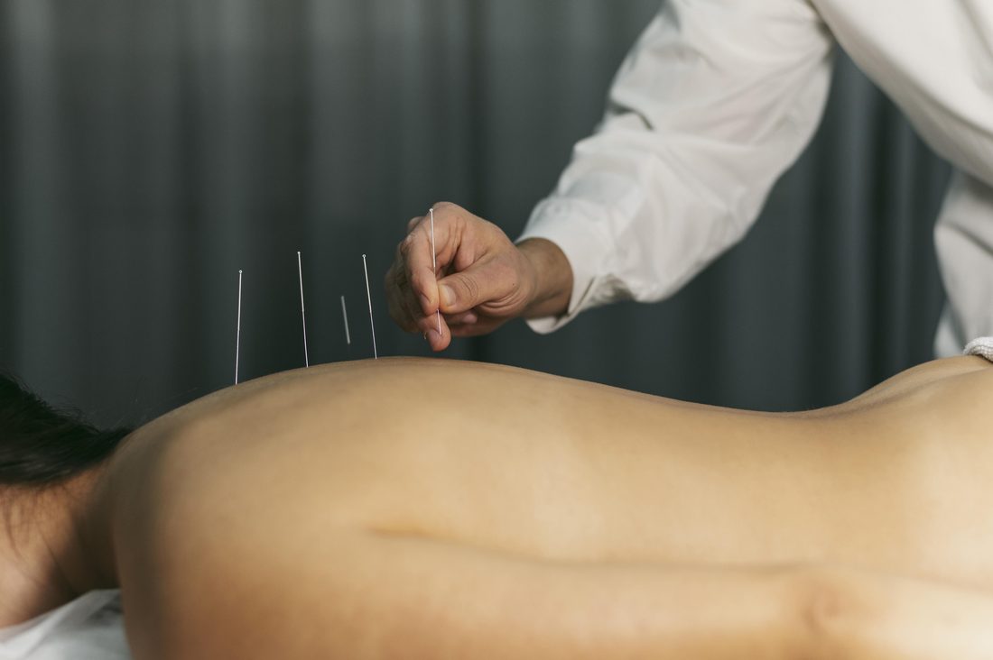 Registered Acupuncturist placing fine acupuncture needles along a patient's back